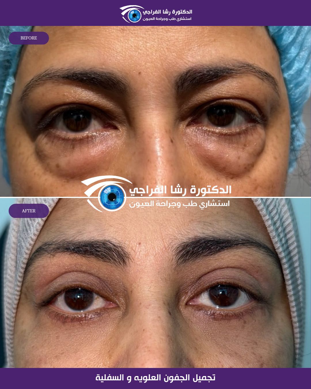 قالب جفون جديد رشا_20260818_223356_٠٠٠٠6408491440031036648.