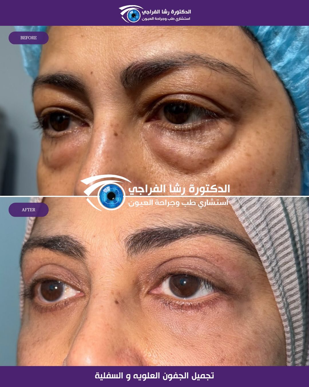 قالب جفون جديد رشا_20260818_223356_٠٠٠١6039886446821698082.